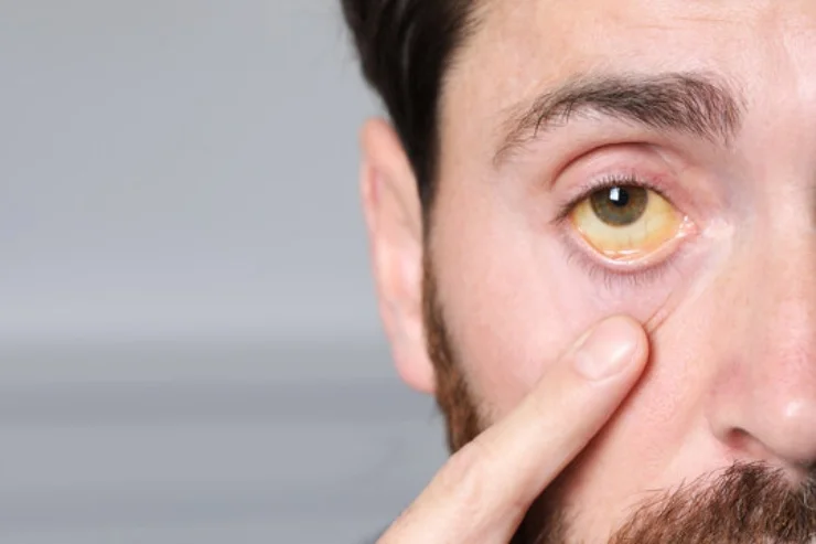 Jaundice
